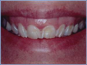 Description: http://www.cosmeticdentistglebe.com.au/wp-content/themes/kiseki/gallery/10-before.jpg